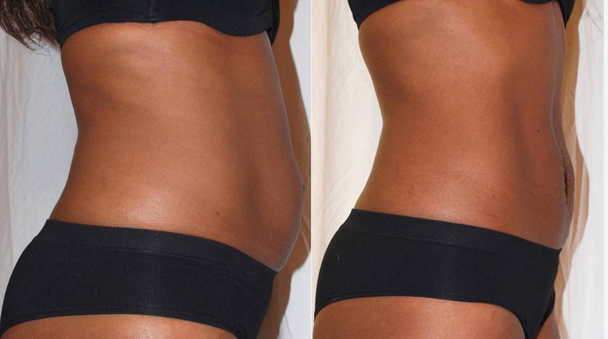Inch-Loss-Before-and-After-laser-treatment-for-stomach.jpg