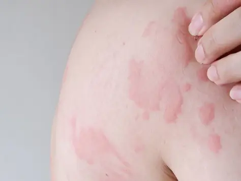 香港人常說的風癩、風LAN,正式名稱為蕁蔴疹(Urticaria, Hives),中醫又叫癮疹