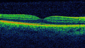 Colour image of an optical coherence tomography retinal scan