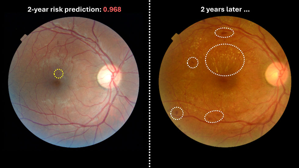 At left, a photo of a retinal image with a small haemorrhage visible. On the right side is a retinal photo of the same eye two years later, showing features of sight-threatening diabetic retinopathy, including haemorrhages and yellow spots indicative of leaking blood vessels.
