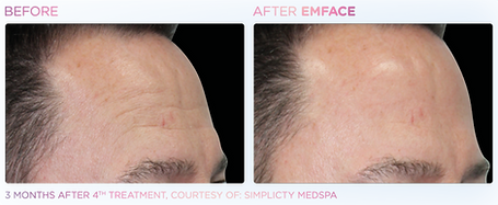 Emface_PIC_Ba-card-male-forehead-085_ENUS100.png