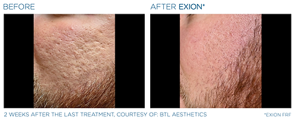 Exion_PIC_Ba-card-cheeks-male-010_FRF_ENUS100.png