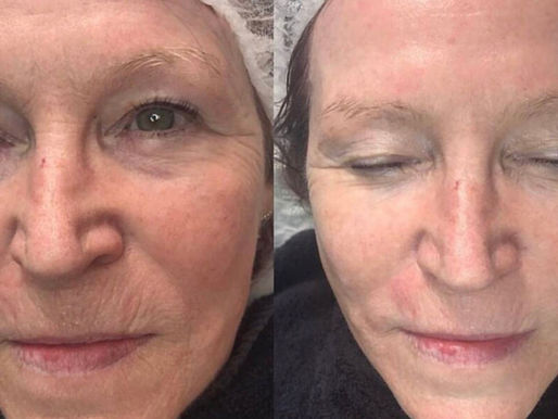 What are Glycolic Acid Peels?