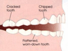 Dental Health and Teeth Grinding (Bruxism)