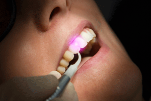 Laser Use in Dentistry