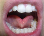 What is a Frenectomy and Why Might You Need One?