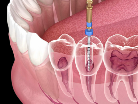 What to Expect During Root Canal Treatment? A Comprehensive Guidelines