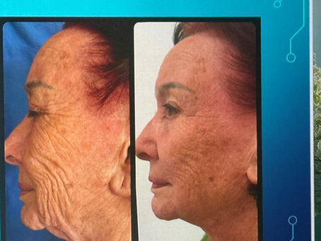 Efekty zabiegów QMR krok po kroku – co zachodzi w skórze po 1., 2., 3. i kolejnych sesjach