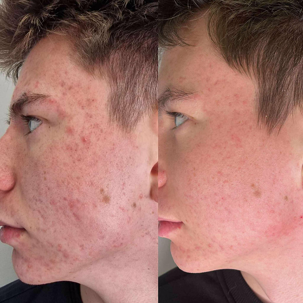 Masz dość trądziku i czerwonej twarzy? Zobacz, jak wyciszyliśmy "ogień" w 2 tygodnie (Bielsko-Biała)