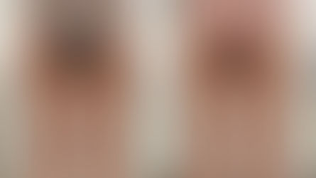 Cellulit na udach po 40-tce? Agnieszka wybrała nowość – Endermologię Infinity w Bielsku-Białej