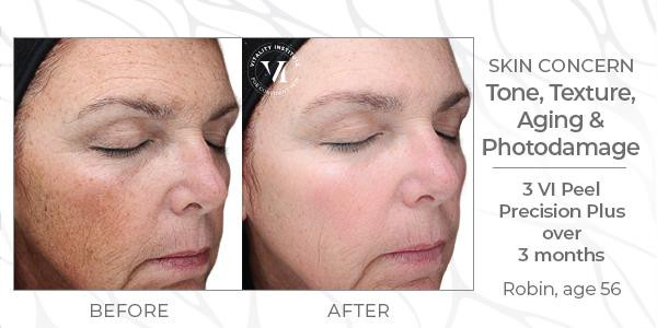 a before and after of a vi peel patient with skin tone, texture, aging, photodamage concerns who did three Vi Peel Precision Plus treatments over the course of 3 months.