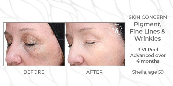 a before and after of a vi peel patient with pigment, fine lines, and wrinkles who did three Vi Peel Advanced treatments over the course of 4 months.