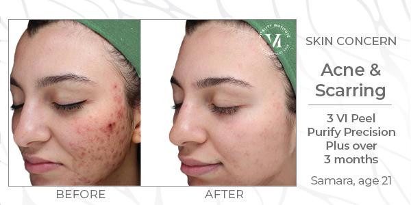a before and after of a vi peel patient with active acne and acne scarring who did three Vi Peel Purify with Precision Plus treatments over the course of 3 months.