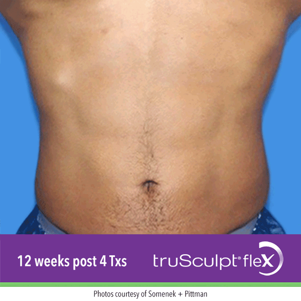 EMSculpt vs. truSculpt fleX: Which Is The Best Muscle Toning Treatment?