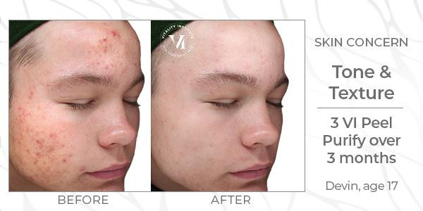 a before and after of a vi peel patient with skin tone and texture concerns who did three Vi Peel Purify treatments over the course of 3 months.
