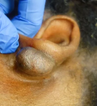 Black Dermatologist Directory, Keloids, Black Skin Dermatology, Black Derm Skin Experts, African American Dermatologist, Skin of Color Dermatology