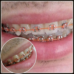 Elasticos fluorescentes Fio Niti