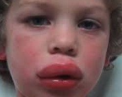 child anphlaxis.jpg