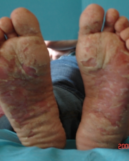 DERMATITIS.png