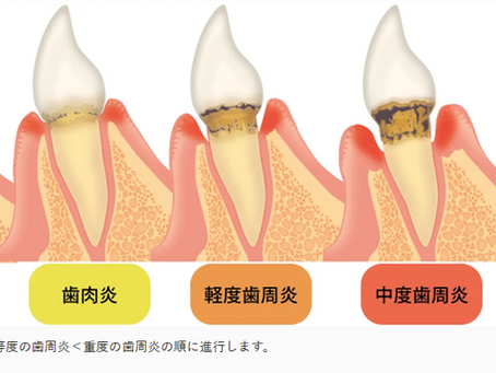 歯周病が怖い本当の理由とは！