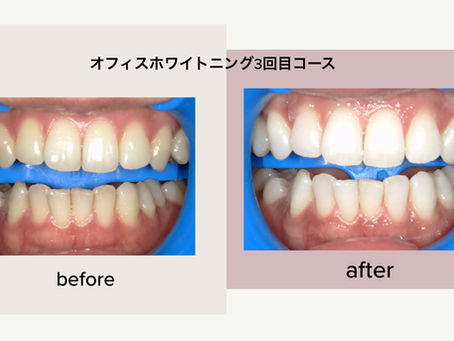 歯のホワイトニング🦷🤍