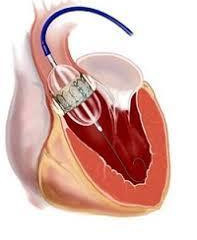 Live TAVR Case Series Study
