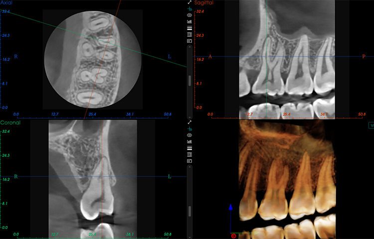 Thumbnail: MEYER CBCT- Your Reliable Choice