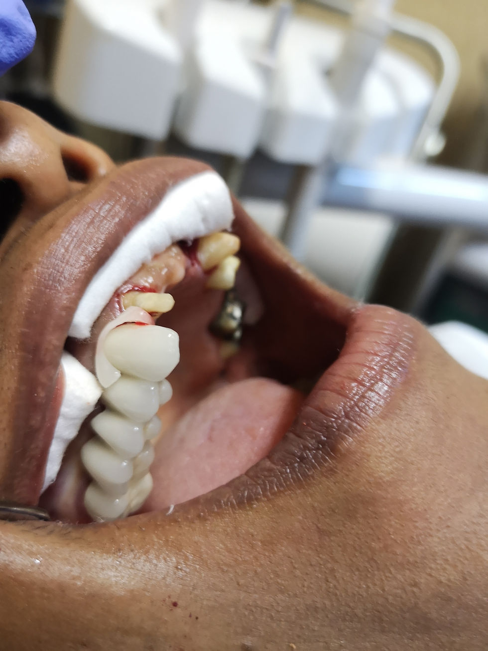 Thumbnail: U-CEM PREMIUM Dual Cure Cement