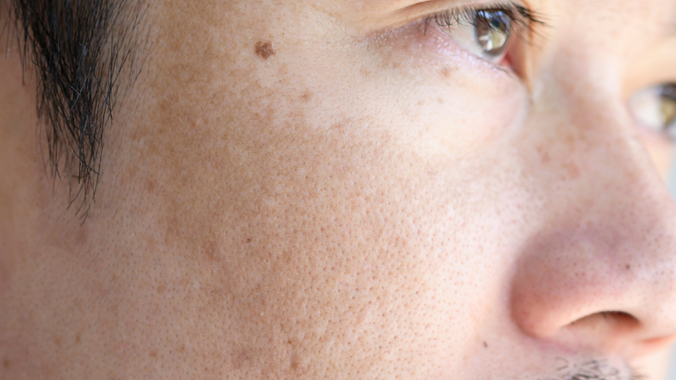 Man with facial pigmentation and uneven skin tone