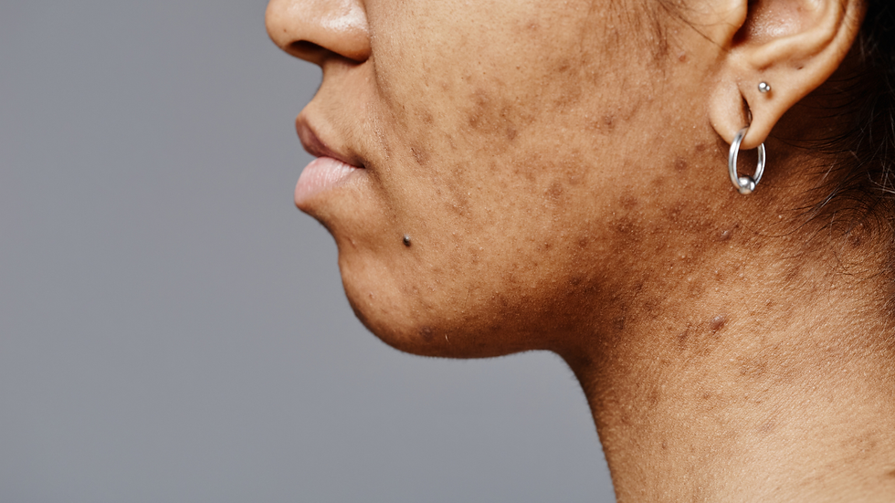 Woman checking dark spots and pigmentation on her face