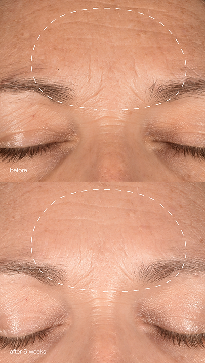 9x16 B&A melanopro peel system 3.png