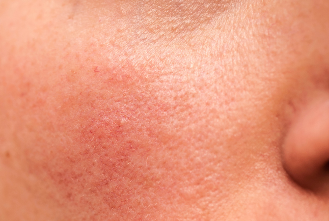 Close-up of red inflamed sensitive skin showing irritation and skin barrier damage