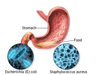 Could Your IBS Have Started After Food Poisoning? Here's What You Need to Know