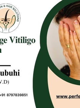 How to Control Vitiligo? - Effective Tips and Treatments