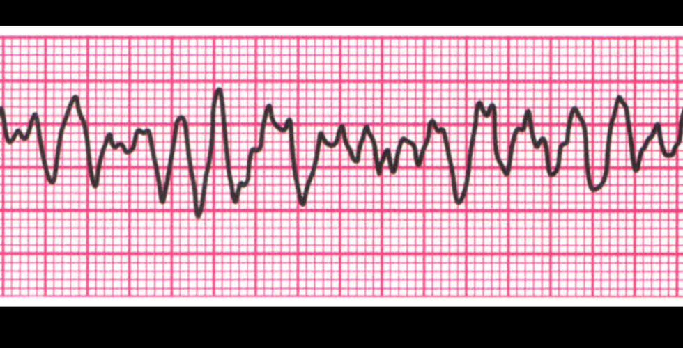 Fibrilación Ventricular (FV)