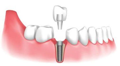 dental-implant-2.jpg
