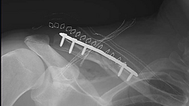 Kaden Hopkins has five screws inserted to fix broken collarbone