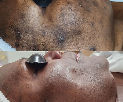 Acne Scars Hyperpigmentation Dark Spots Sun Facial