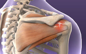 torn rotator cuff.jpeg