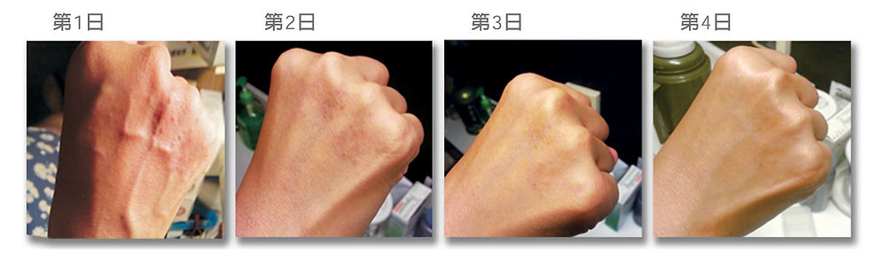 濕疹手又紅又癢 case