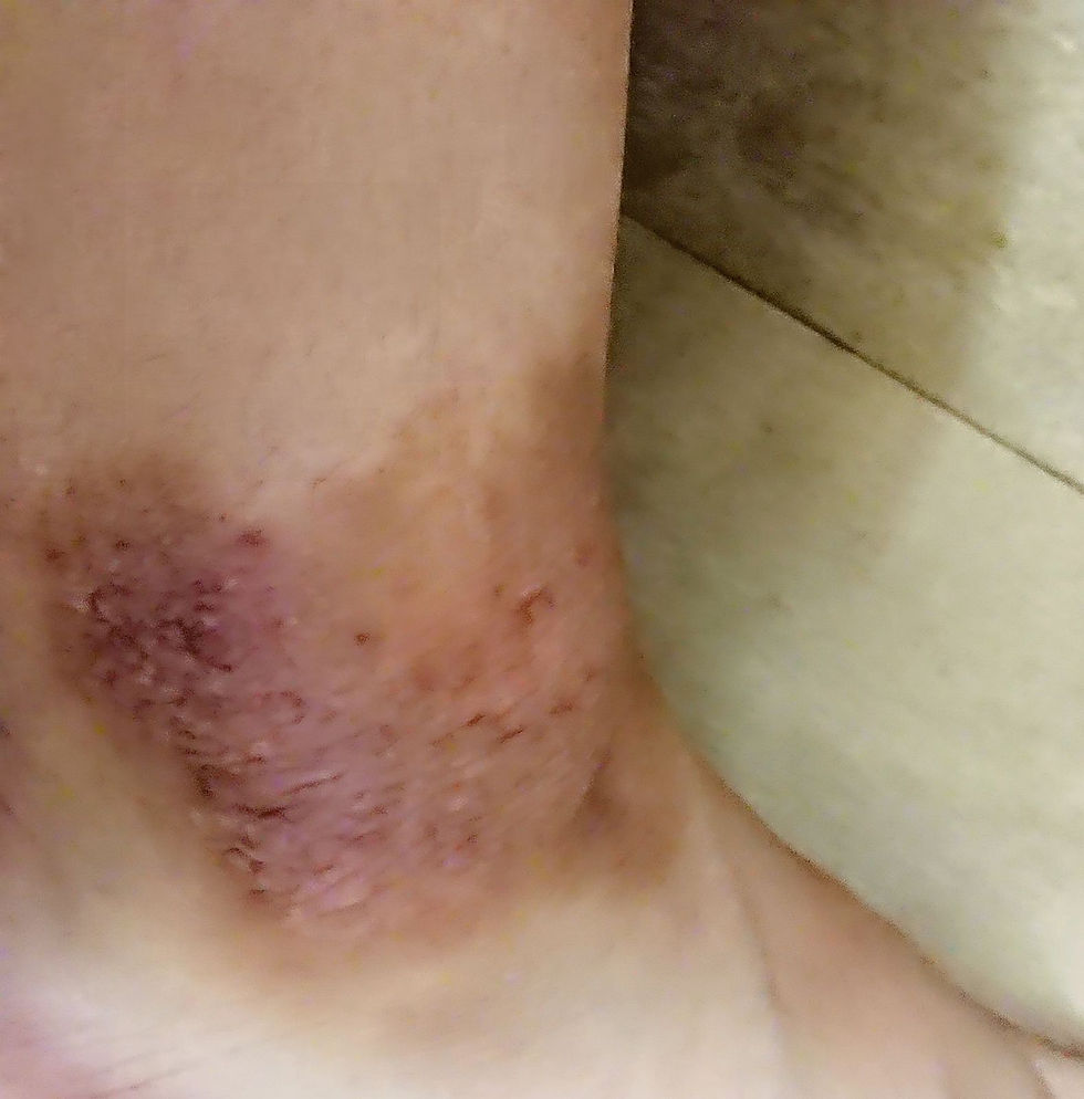 更引發到手腳都有濕疹