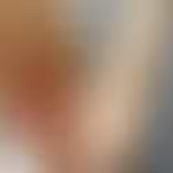 Procalun濕疹萬用膏使用前後對比圖