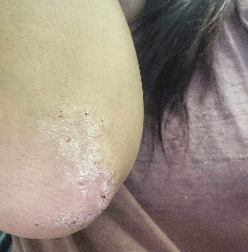 化妝化到濕疹