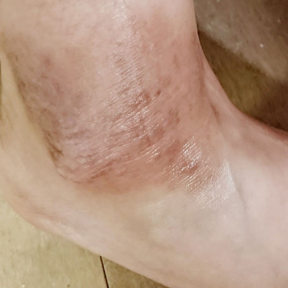 濕疹KO 每日早晚用Carun,皮膚慢慢recover返