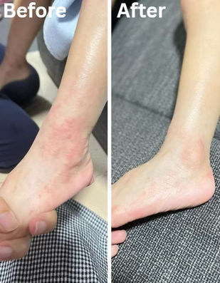 卡倫全效萬用膏擊退濕疹過程