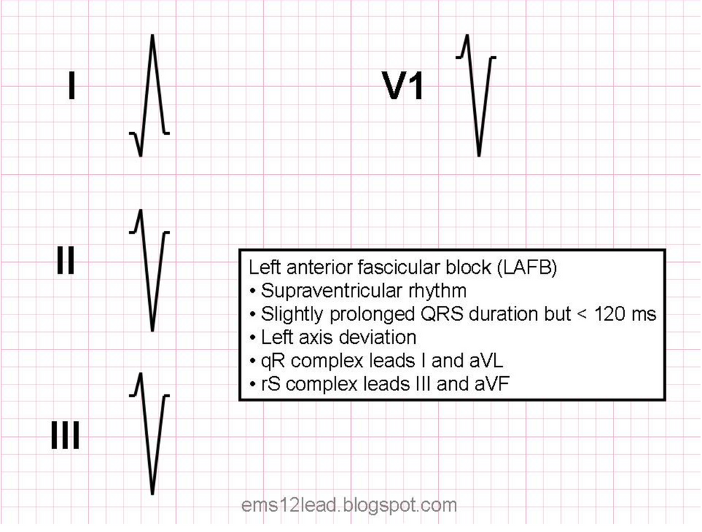 Left Anterior Fascicular Block (LAFB)