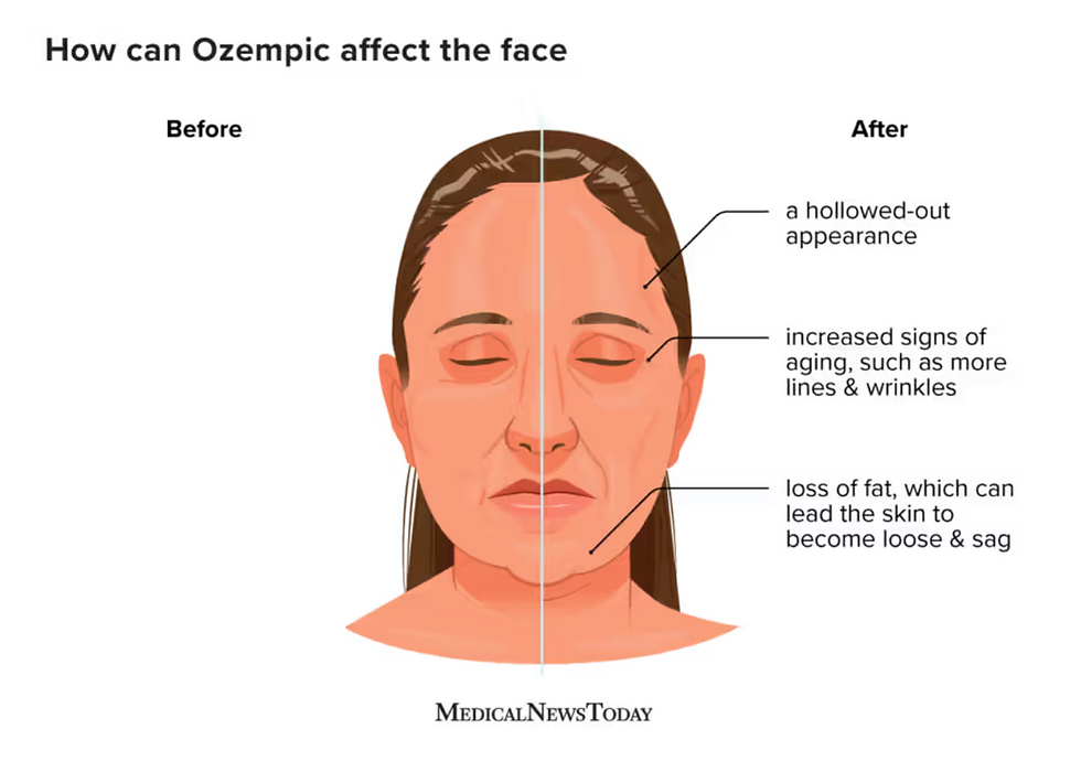 Ozempic face: