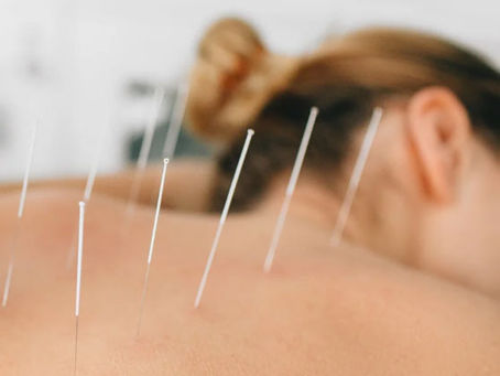 a woman getting acupuncture therapy in burlington vermont