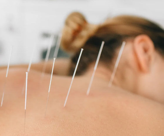 a woman getting acupuncture therapy in burlington vermont