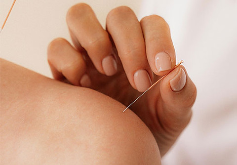 acupuncture in Burlington Vermont